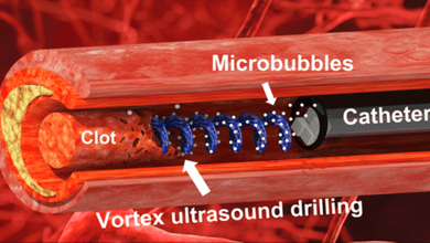 أداة جديدة تستخدم الموجات فوق الصوتية “تورنادو” لتفكيك جلطات الدم