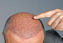 زراعة الشعر: كل ما تريد معرفته