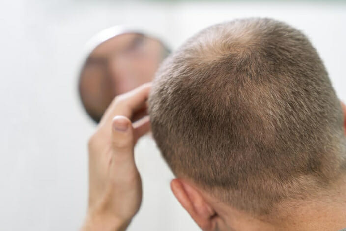 هل تم اكتشاف علاج لتساقط الشعر؟ يقول العلماء أن لديهم الحل
